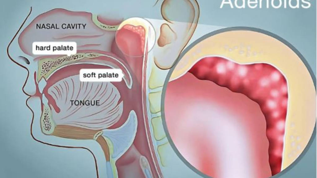 Adenoidid