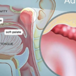 Adenoidid